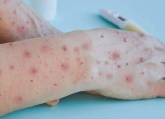 Barra Velha confirma primeiro caso de Monkeypox