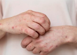 Navegantes confirma primeiro caso de Monkeypox